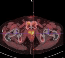 EVESIO - Centres de Médecine Nucléaire - TEP Choline Oncologie Prostate